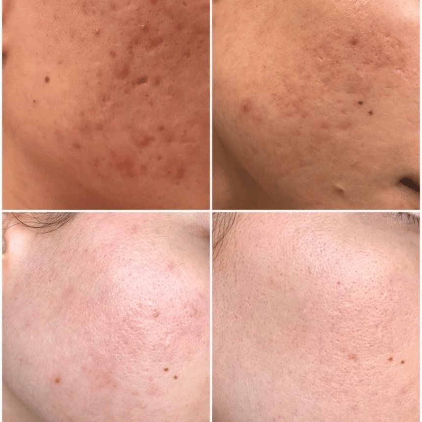 Tratamento de cicatrizes de acne