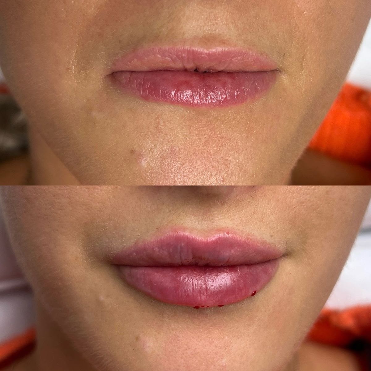 Antes e depois de preenchimento labial