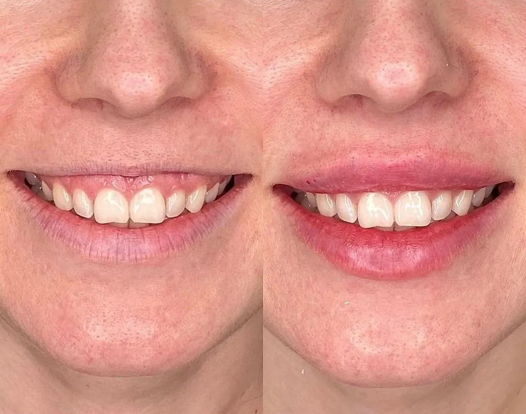 Antes e depois da correção de sorriso gengival com toxina botulínica