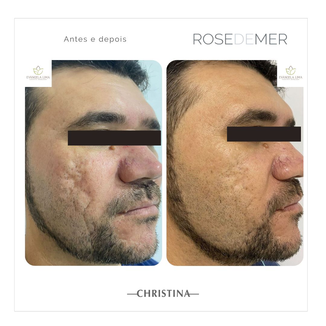 Antes e depois de tratamento facial em Florianópolis