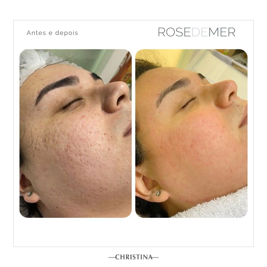 Antes e depois de tratamento facial em Florianópolis
