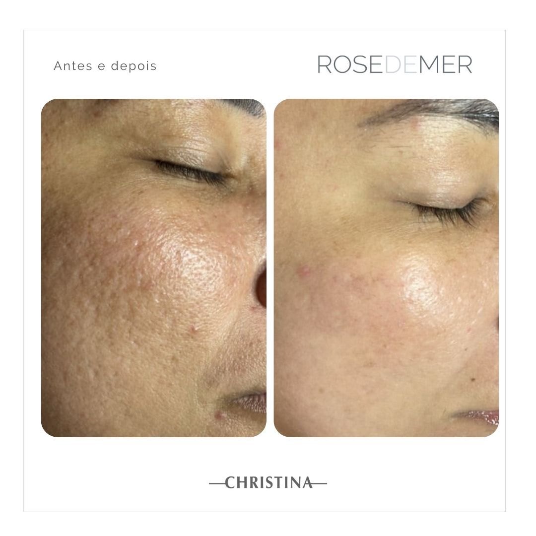 Antes e depois de tratamento facial em Florianópolis
