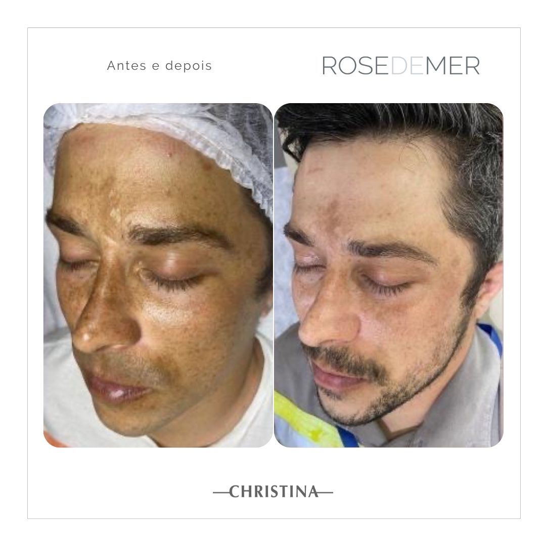 Antes e depois de tratamento facial em Florianópolis