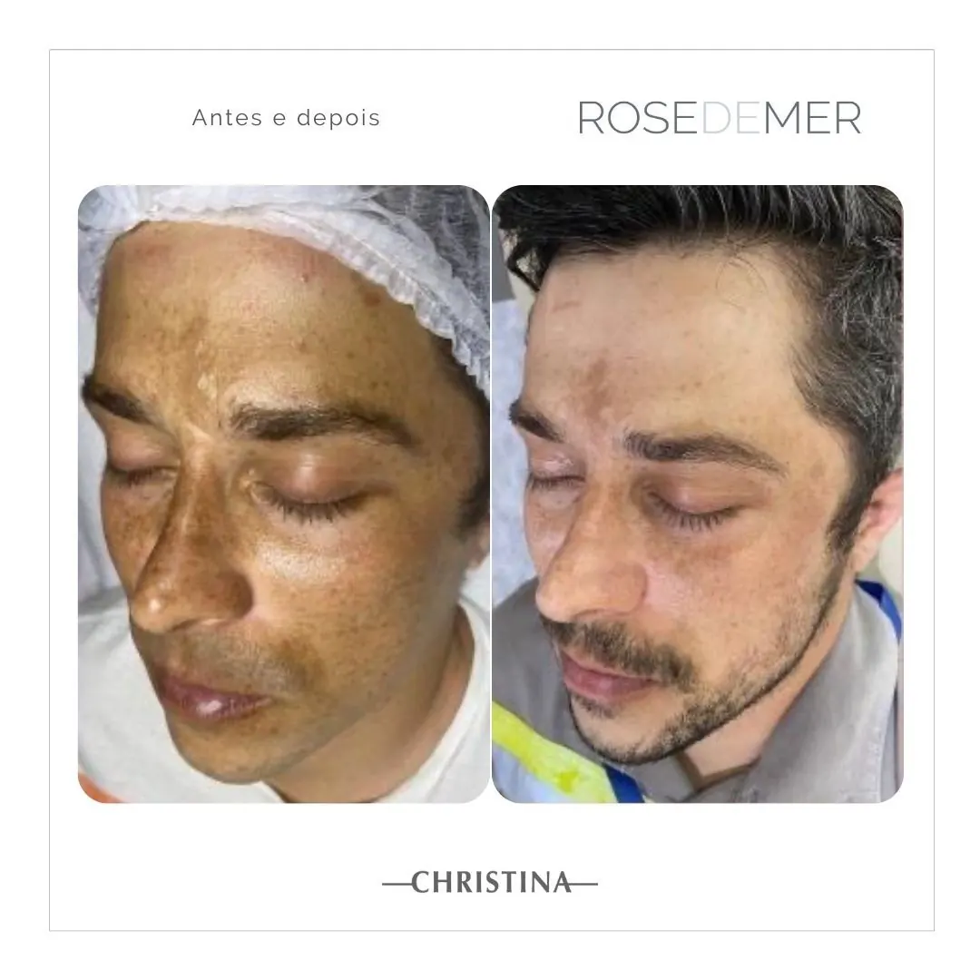 Antes e depois de limpeza de pele profunda em Florianópolis