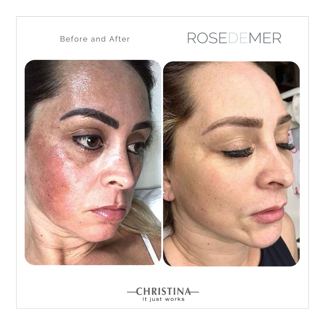 Antes e depois de tratamento facial em Florianópolis