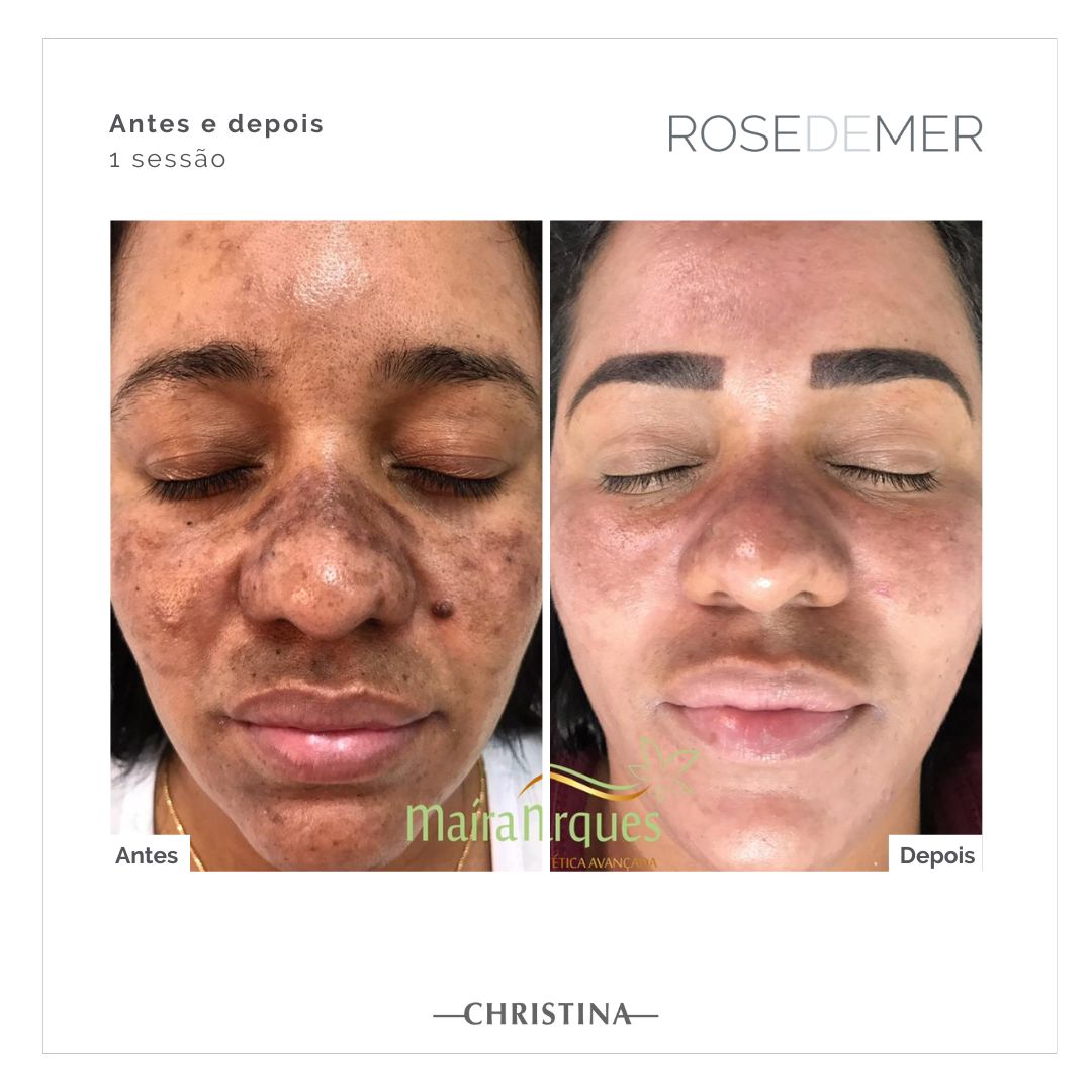 Antes e depois de tratamento facial em Florianópolis