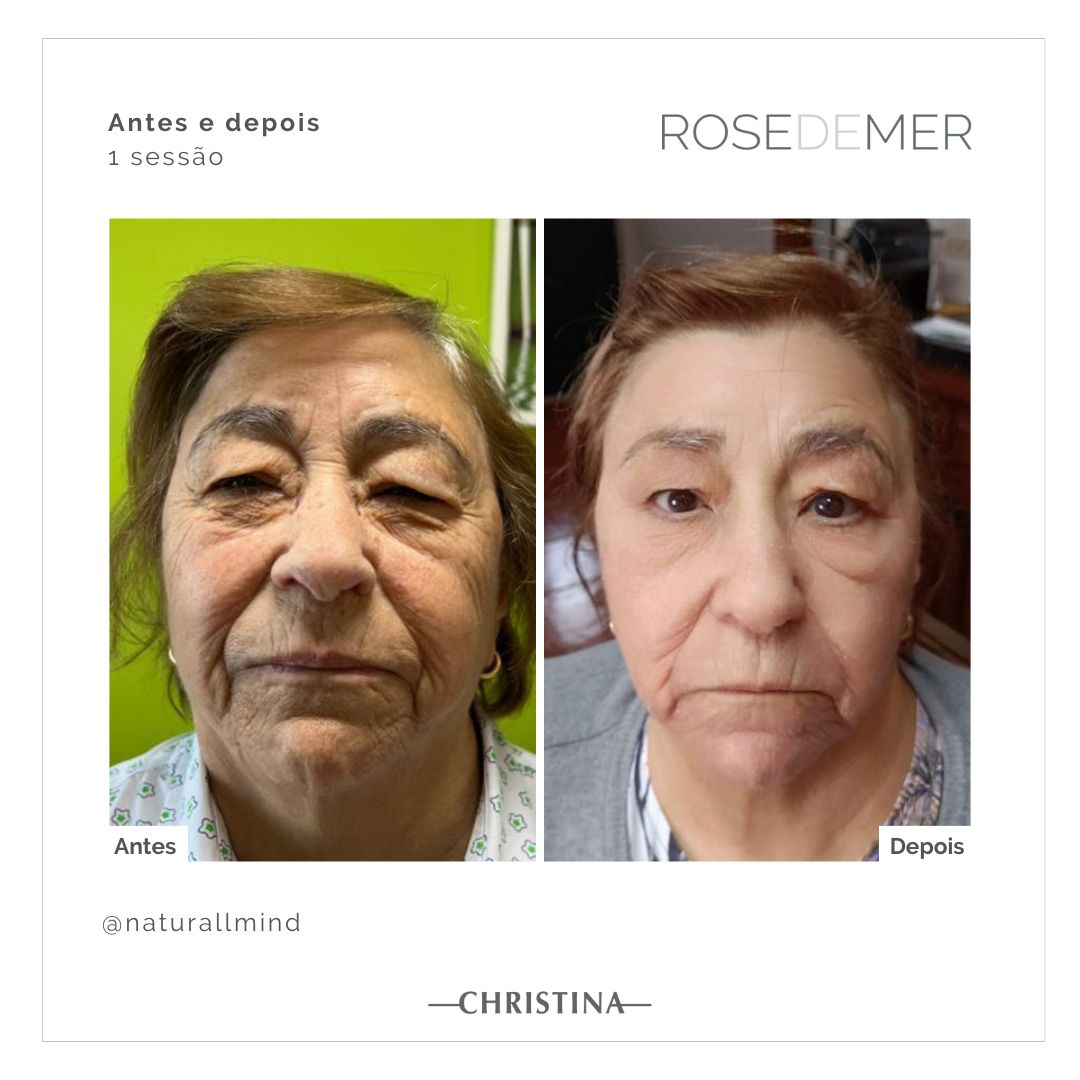 Antes e depois de tratamento facial em Florianópolis