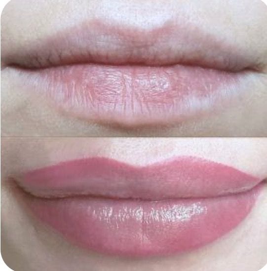 Antes e depois de preenchimento labial em Florianópolis