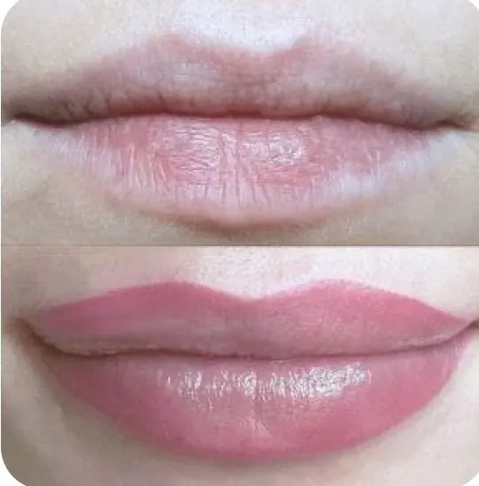 Antes e depois de preenchimento labial em Florianópolis — paciente da Dra. Matilde