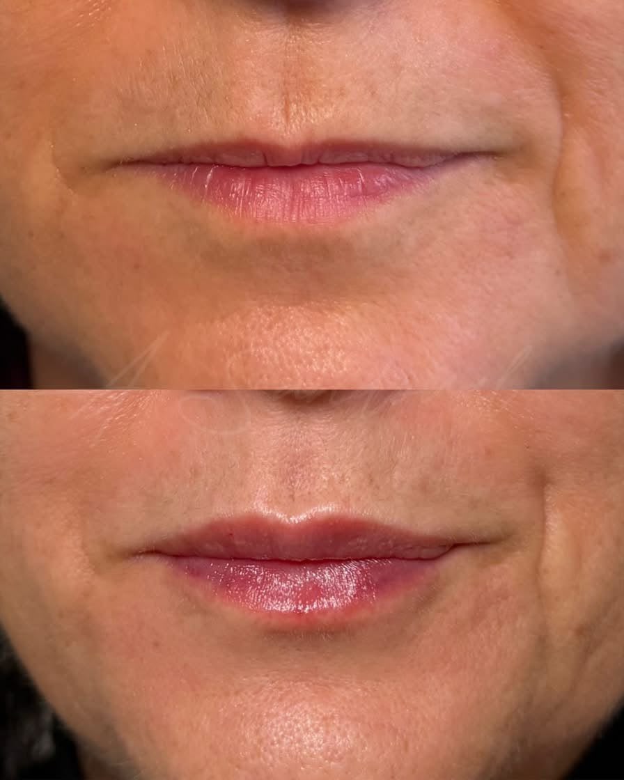 Antes e depois de preenchimento labial em Florianópolis