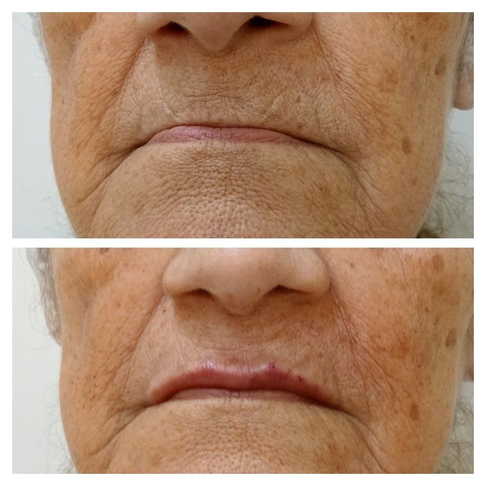 Antes e depois de preenchimento labial em Florianópolis