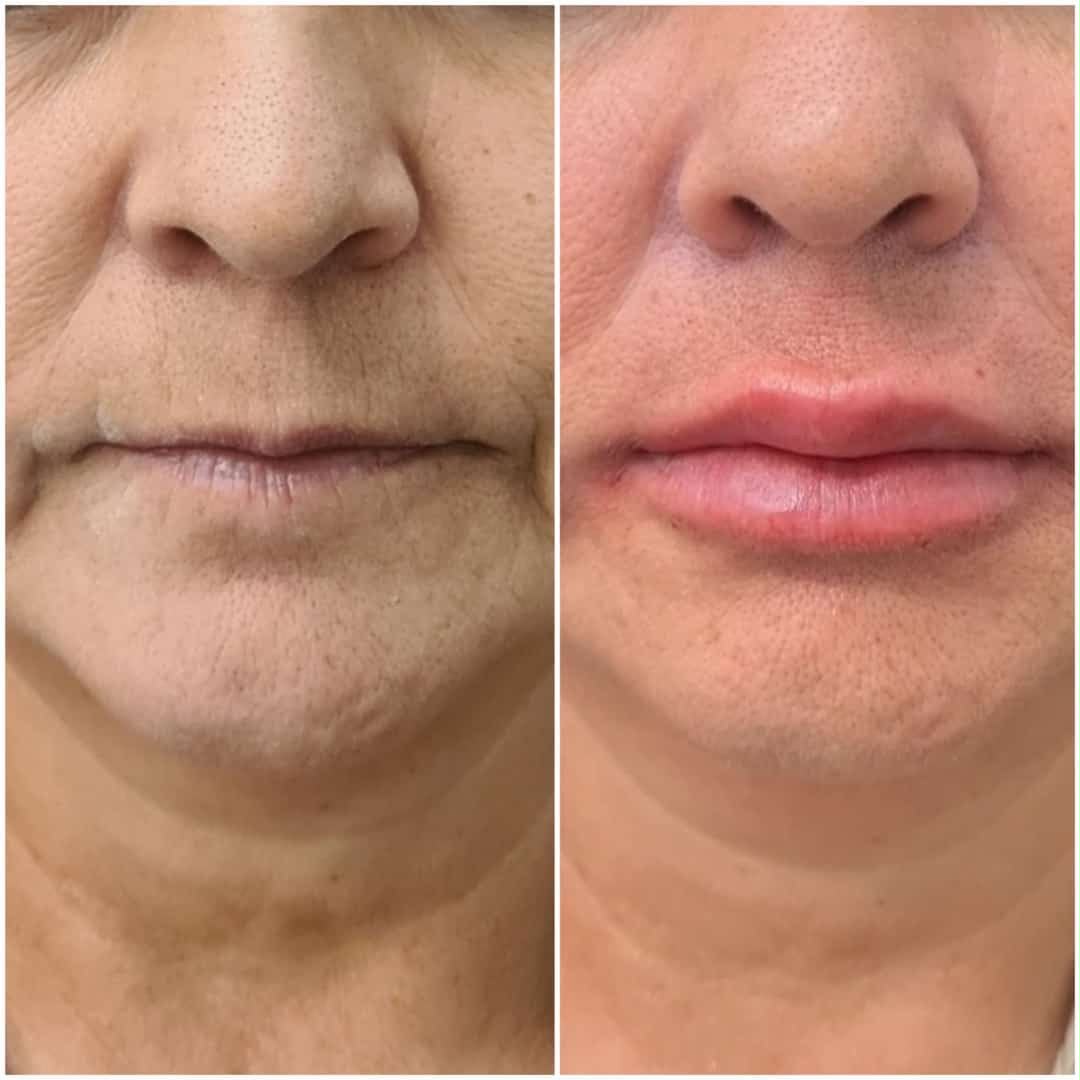 Antes e depois de preenchimento labial em Florianópolis