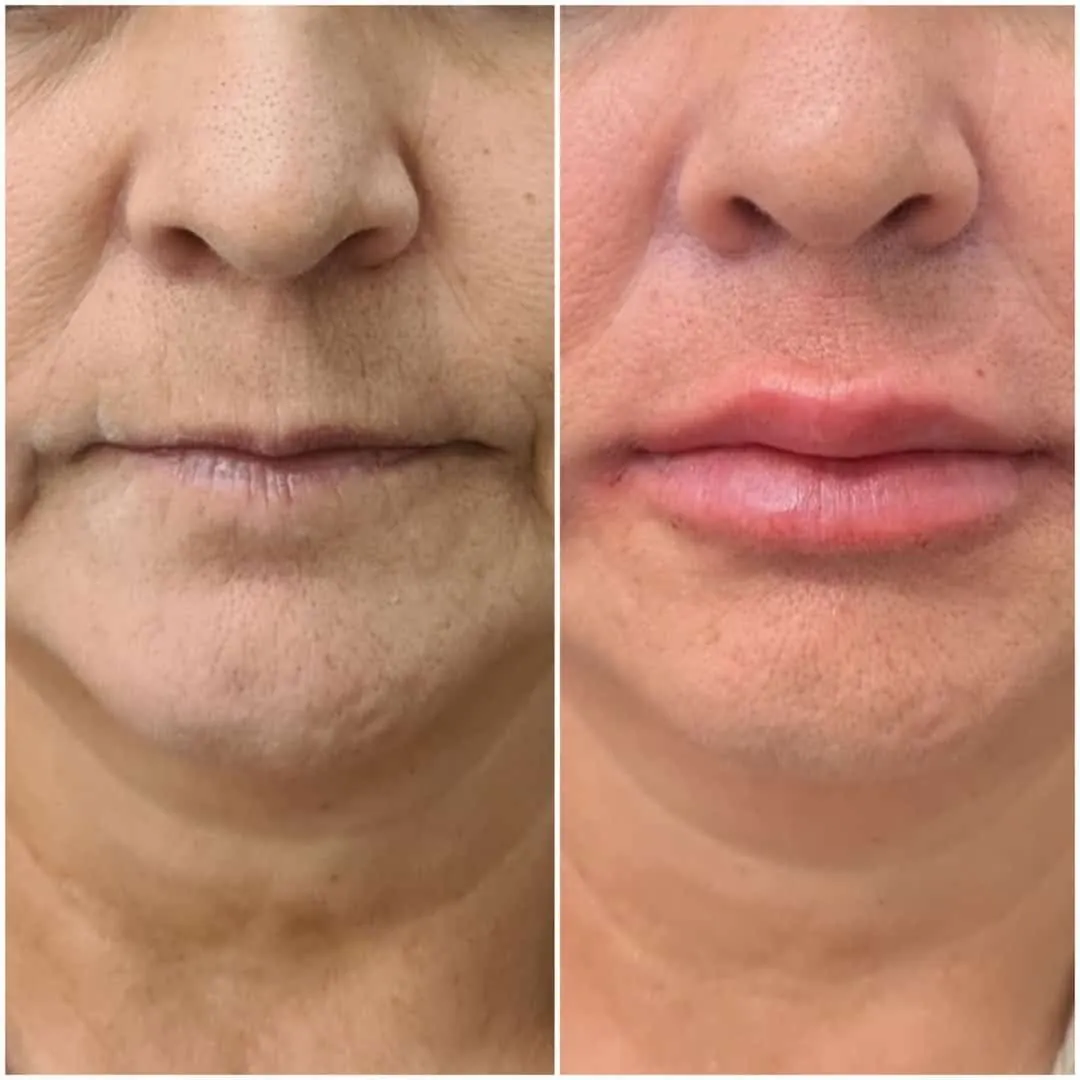 Antes e depois de preenchimento labial em Florianópolis