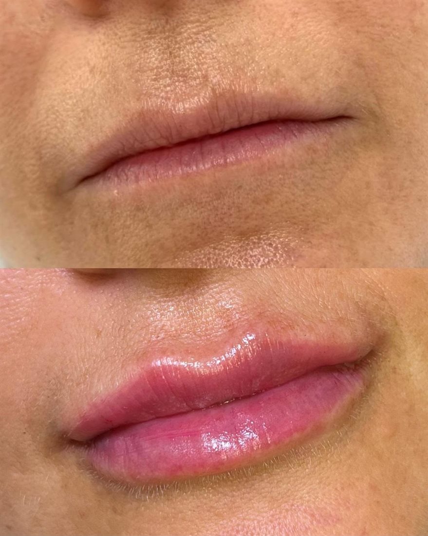 Antes e depois de preenchimento labial em Florianópolis