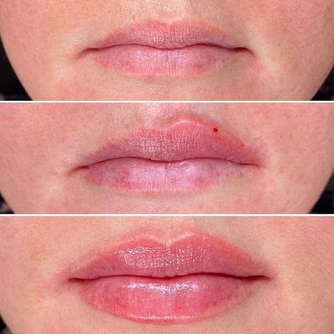 Antes e depois de preenchimento labial em Florianópolis