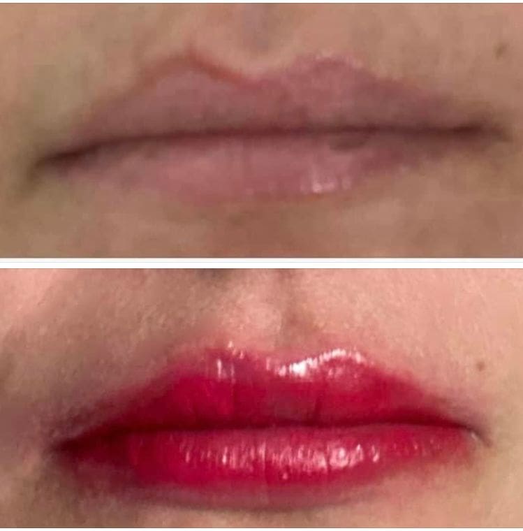 Antes e depois de preenchimento labial em Florianópolis