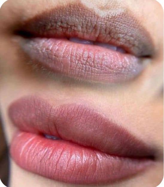 Antes e depois de preenchimento labial em Florianópolis