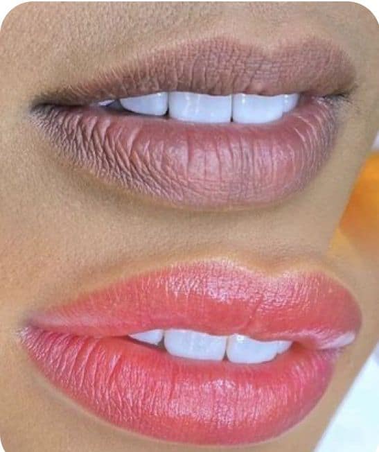 Antes e depois de preenchimento labial em Florianópolis