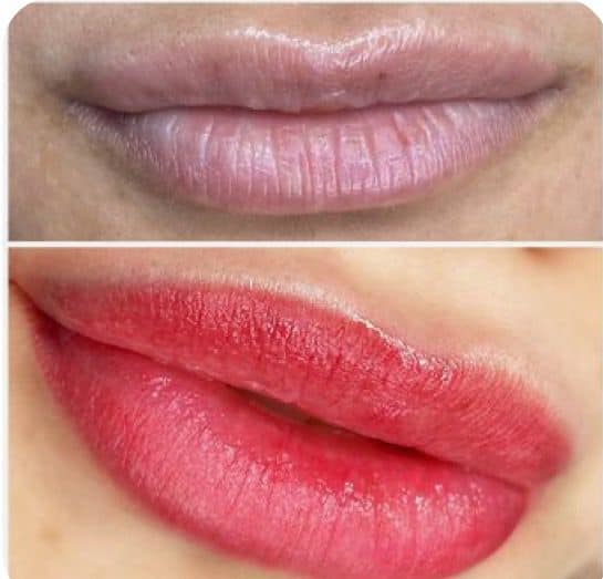 Antes e depois de preenchimento labial em Florianópolis