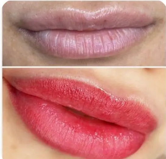 Antes e depois de preenchimento labial em Florianópolis — paciente da Dra. Matilde