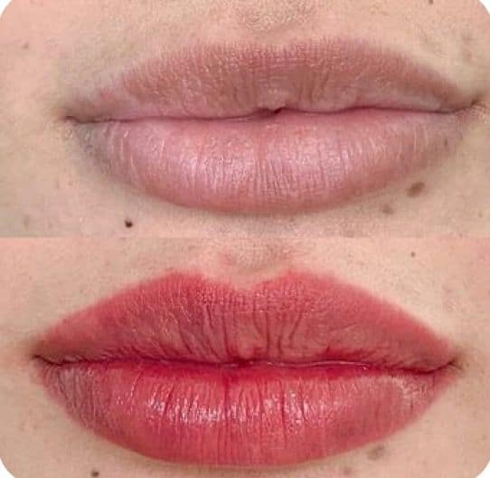 Antes e depois de preenchimento labial em Florianópolis