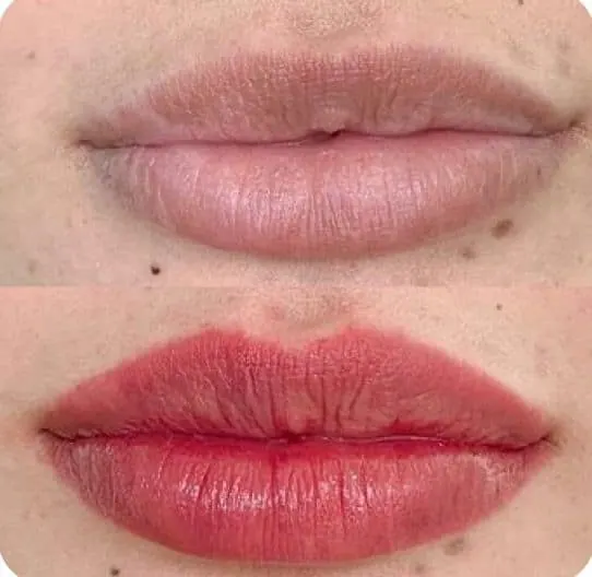 Antes e depois de preenchimento labial em Florianópolis — paciente da Dra. Matilde