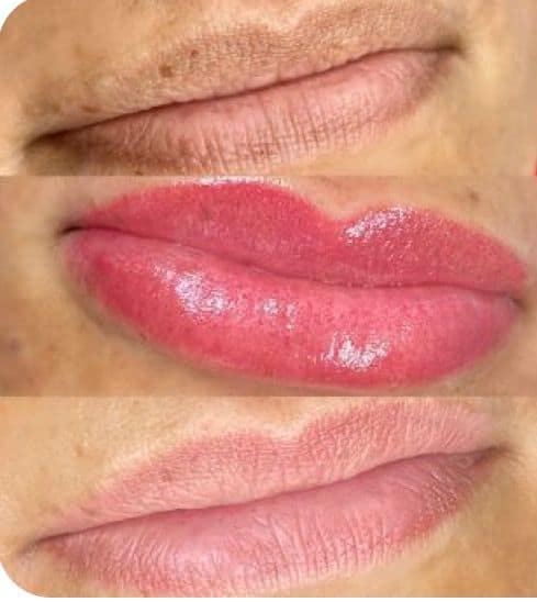 Antes e depois de preenchimento labial em Florianópolis