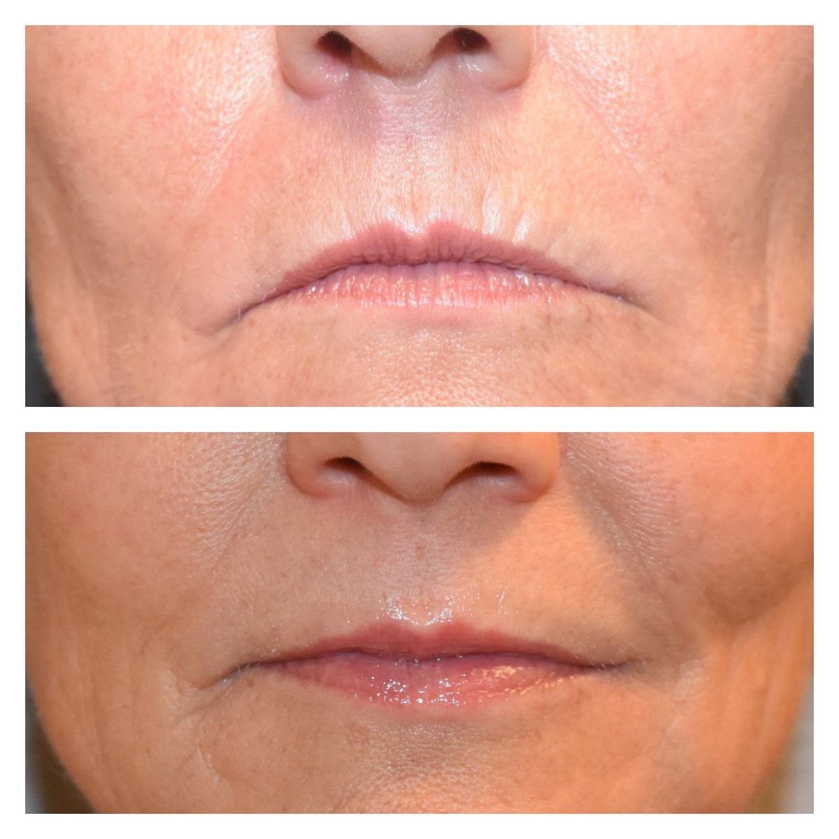 Antes e depois de preenchimento labial em Florianópolis