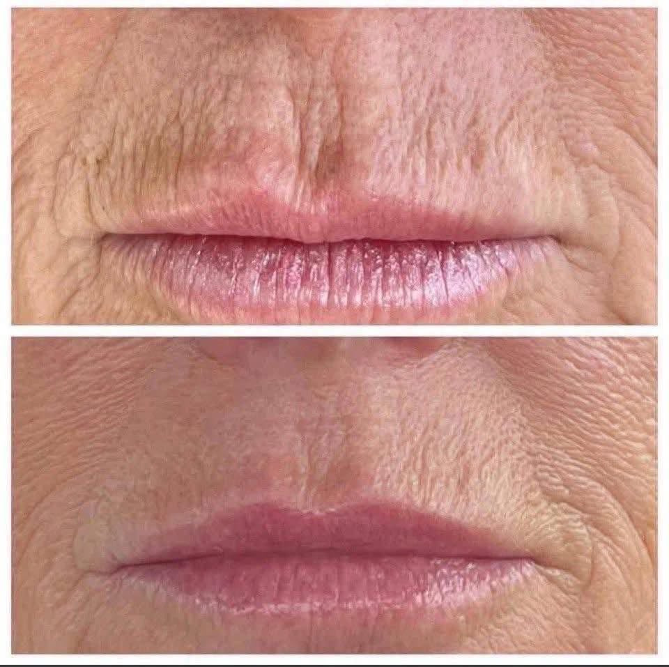 Antes e depois de preenchimento labial em Florianópolis