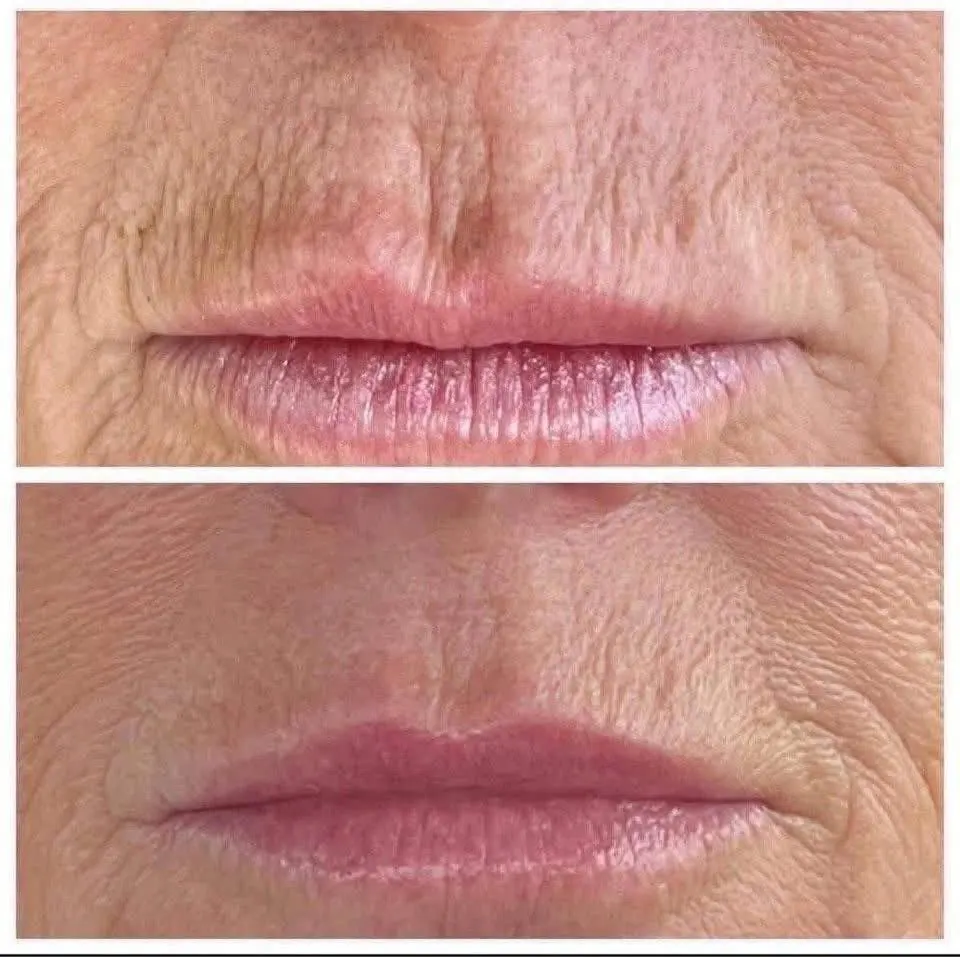 Antes e depois de preenchimento labial em Florianópolis — paciente da Dra. Matilde