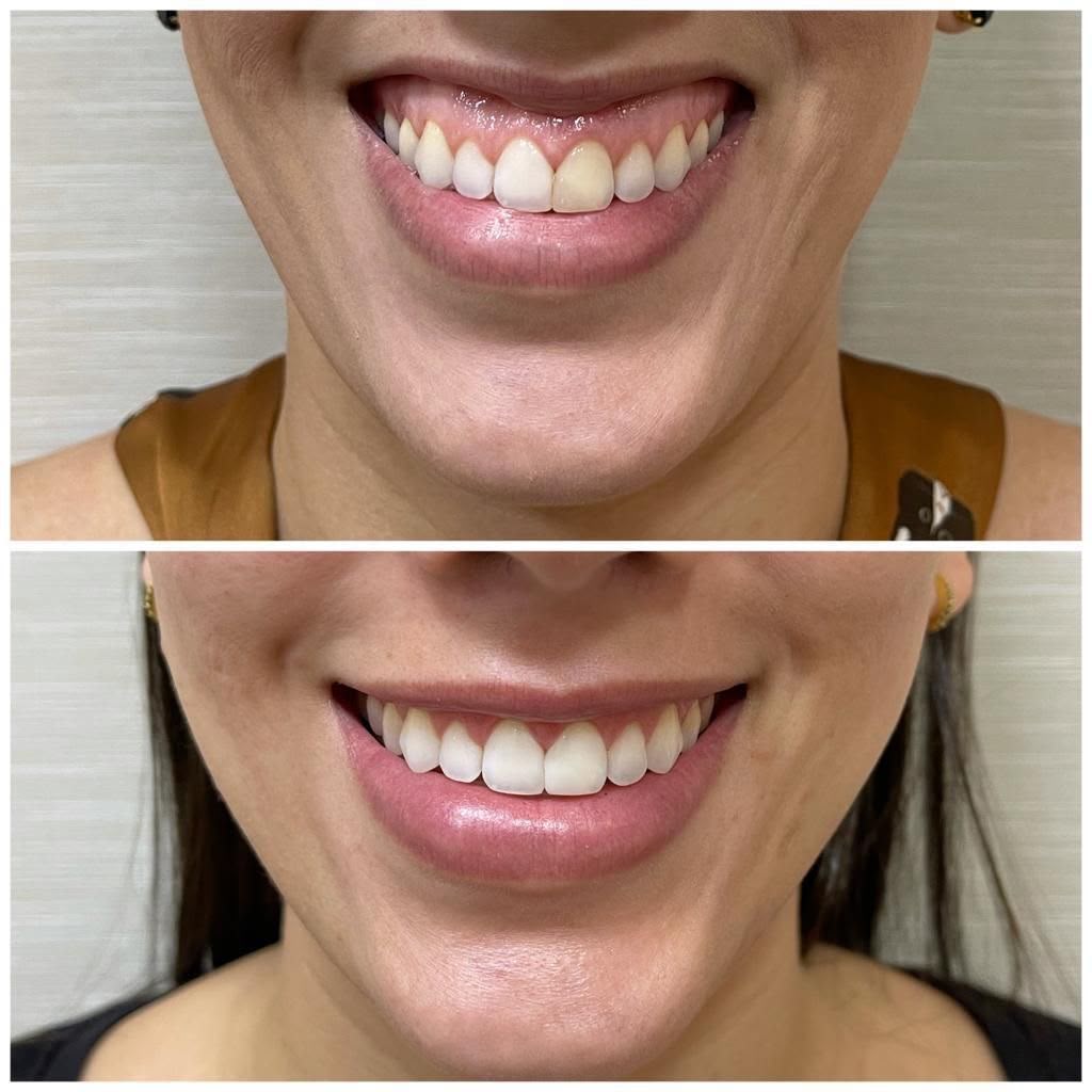 Antes e depois de correção de sorriso gengival com toxina botulínica em Florianópolis