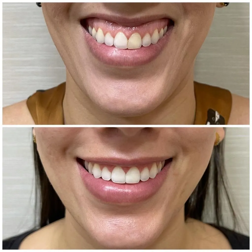 Antes e depois de correção de sorriso gengival com toxina botulínica em Florianópolis