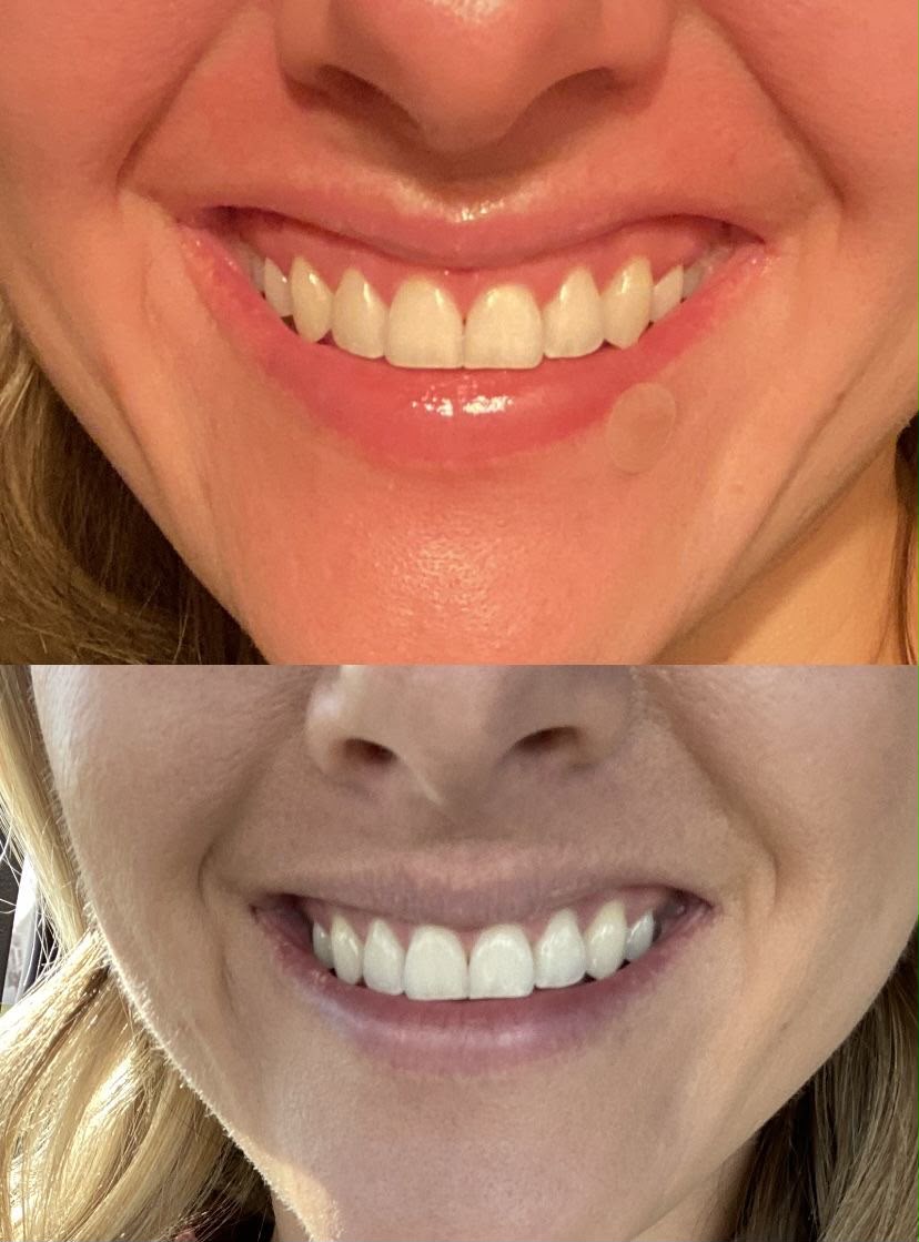 Antes e depois de correção de sorriso gengival com toxina botulínica em Florianópolis
