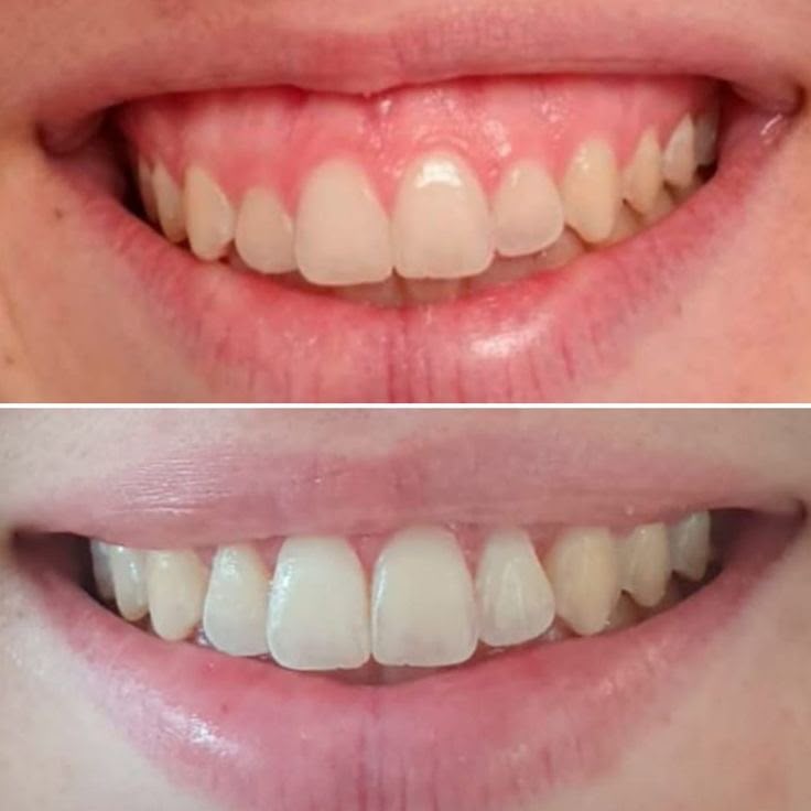 Antes e depois de correção de sorriso gengival com toxina botulínica em Florianópolis