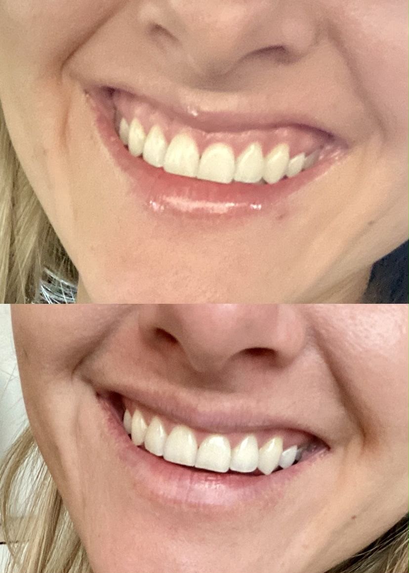 Antes e depois de correção de sorriso gengival com toxina botulínica em Florianópolis