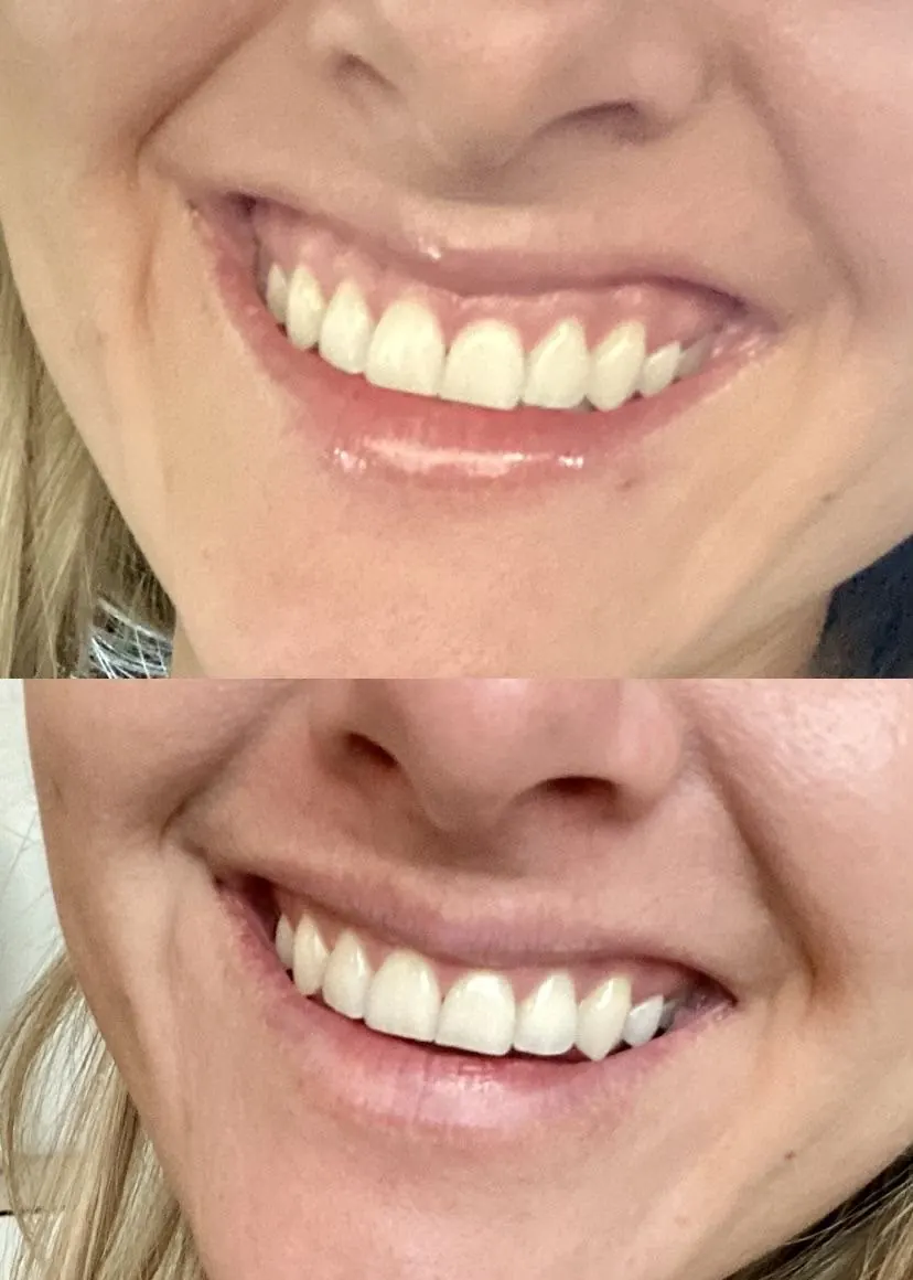 Antes e depois de correção de sorriso gengival com toxina botulínica em Florianópolis