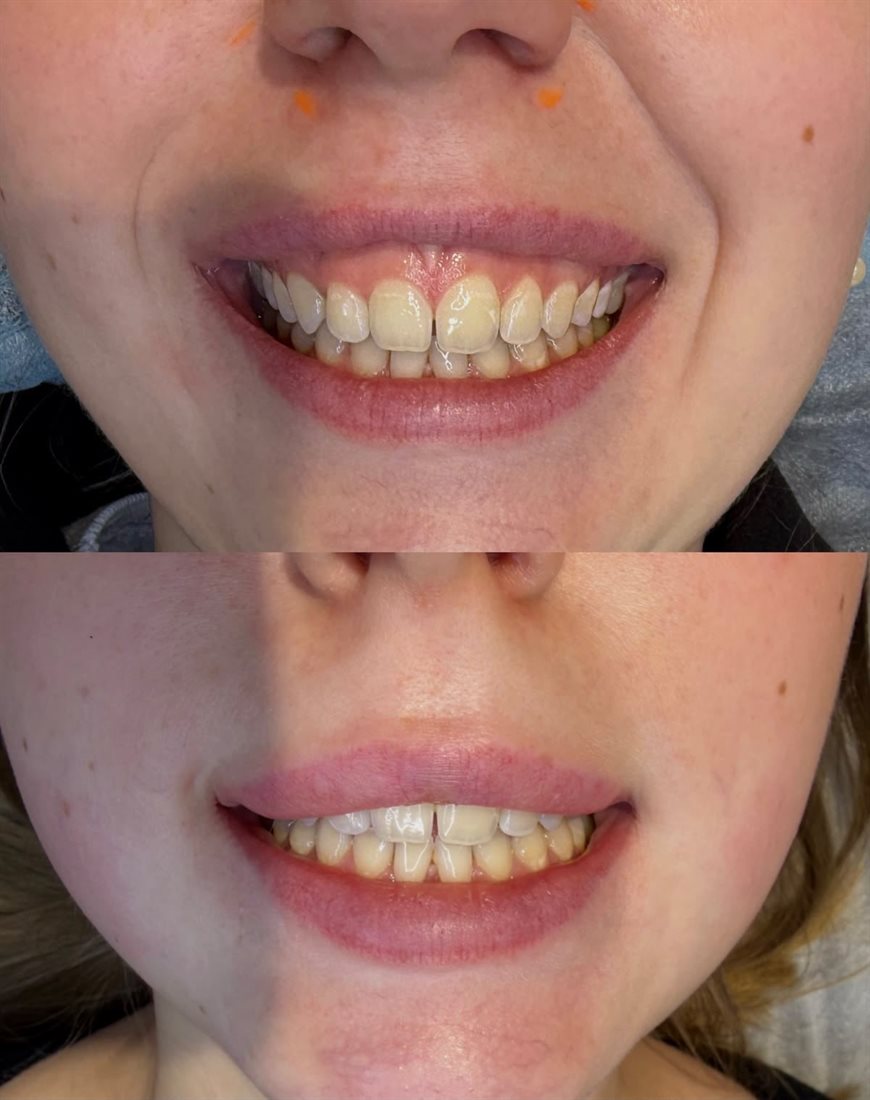 Antes e depois de correção de sorriso gengival com toxina botulínica em Florianópolis