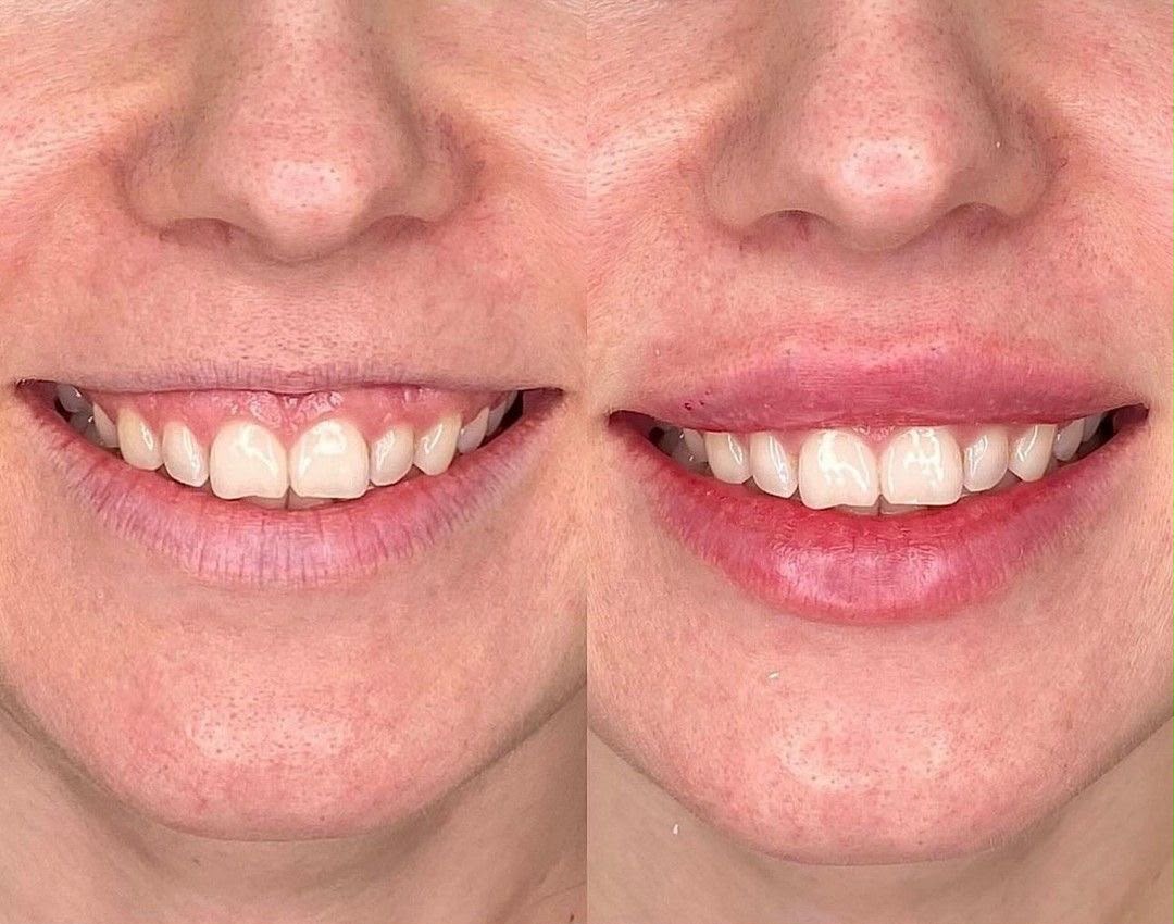 Antes e depois de correção de sorriso gengival com toxina botulínica em Florianópolis